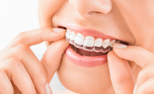 Invisible aligners